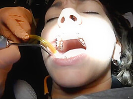 Braces Cleaning, dental fetish